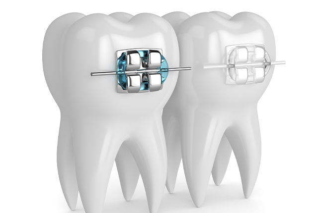 当院の表側矯正(ワイヤー矯正)