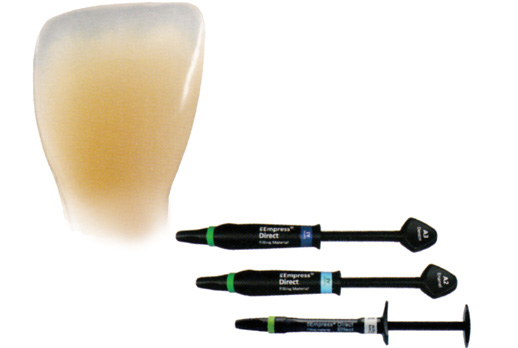 ダイレクトボンディング